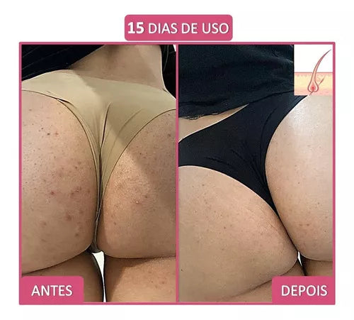 DermaBum✨Crema Exfoliante para la Foliculitis en los glúteos